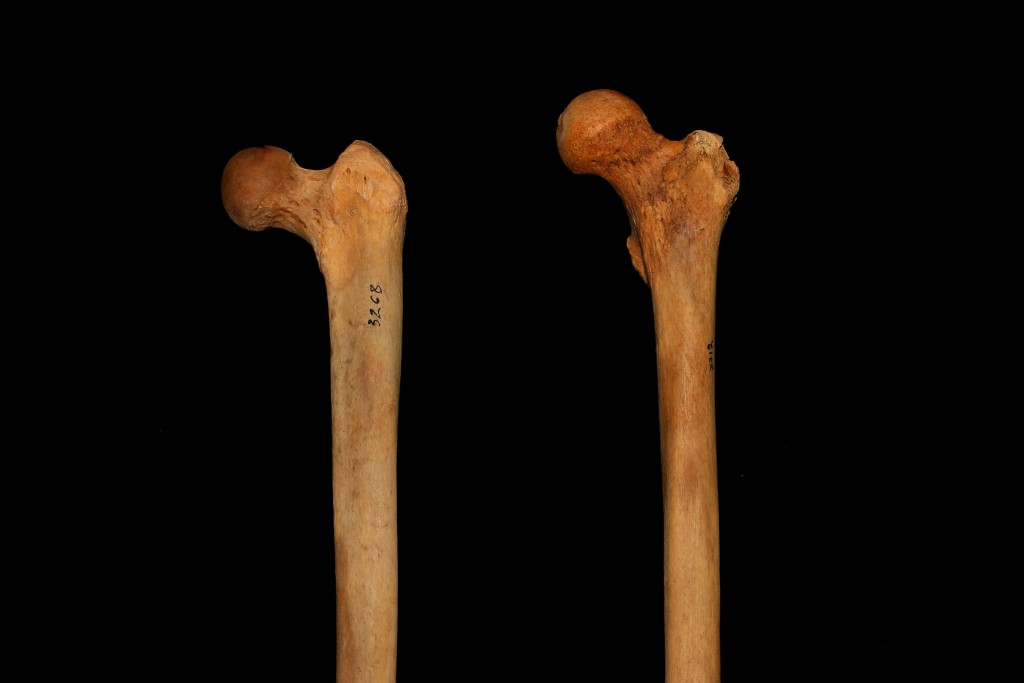 Femur_Inclination